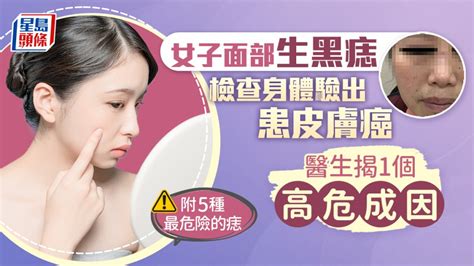 生黑痣|是痣or皮膚癌？醫「1張圖秒對照」 長這2部位最危險